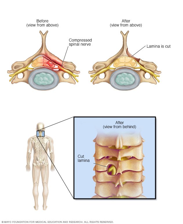 Spinal stenosis Disease Reference Guide Drugs com Spinal stenosis Disease Reference Guide Drugs com