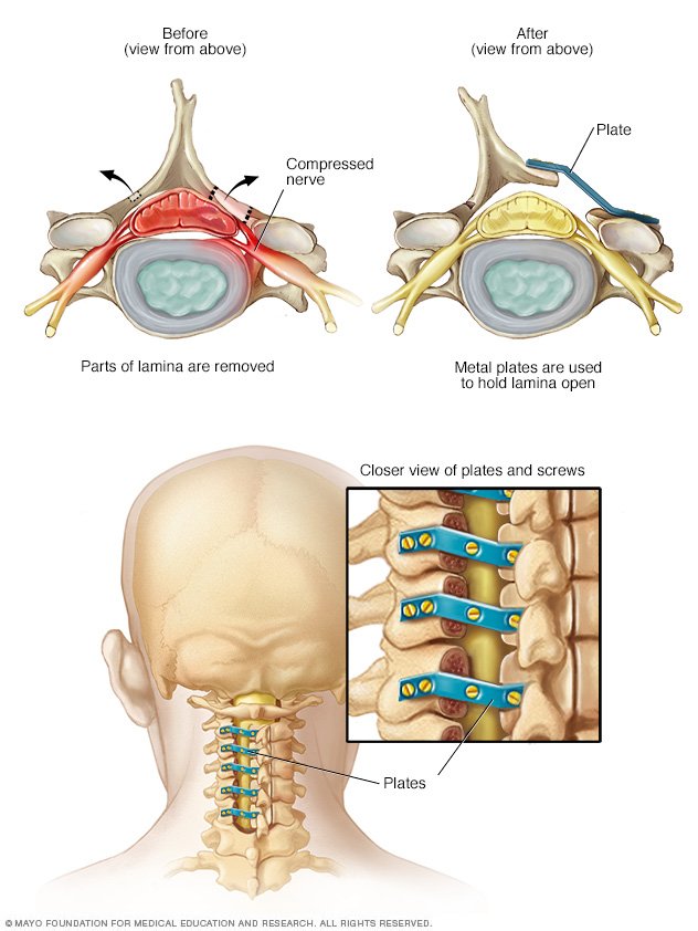 Spinal stenosis Disease Reference Guide Drugs com Spinal stenosis Disease Reference Guide Drugs com