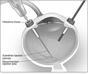 Figure 5a. Subretinal injection cannula introduced via pars plana