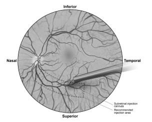 Figure 5b. Tip of the subretinal injection cannula placed within the recommended site of injection (surgeon’s point of view)