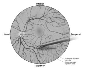 Figure 5b. Tip of the subretinal injection cannula placed within the recommended site of injection (surgeon's point of view)