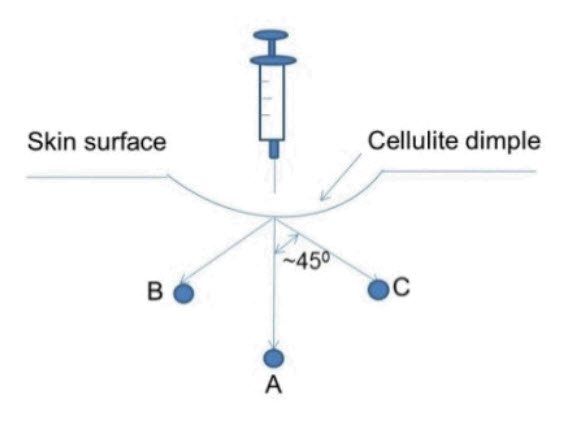 Injection Technique