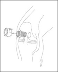 Remove Cannula