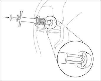 Arthroscopic Delivery