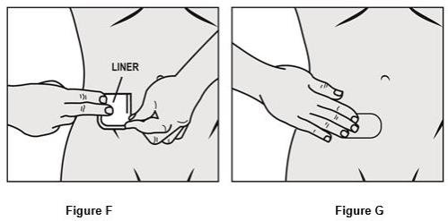 ·	Bend the patch in half and gently roll the remaining part onto your skin using the tips of your fingers. As you roll the patch in place, the second piece of the protective liner should come off the patch. See Figure F.
·	Apply firm pressure over the surface of the patch with your fingers to make sure the patch stays on. See Figure G.
