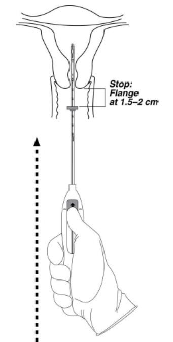 Advancing Flange