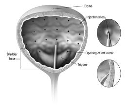 Figure 1: Injection Pattern for Intradetrusor Injections for Treatment of Overactive Bladder and Detrusor Overactivity associated with a Neurologic Condition