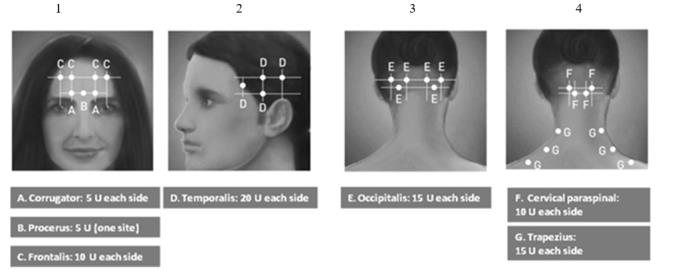 Botox Reconstitution Chart