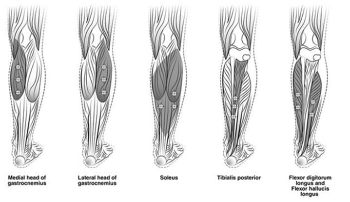 Figure 3: Injection Sites for Adult Lower Limb Spasticity