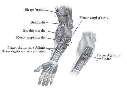 Figure 4: Injection Sites for Pediatric Upper Limb Spasticity