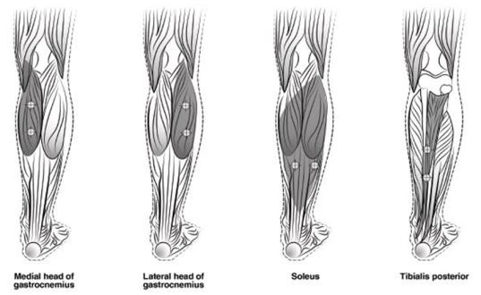 Botox Dosage Guide - Drugs.com