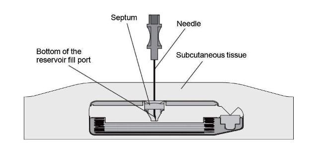 Lioresal Intrathecal Prescribing Information
