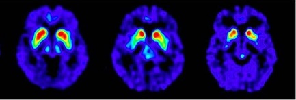 FDOPA Positive Scan