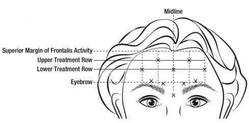 Botox Reconstitution Chart