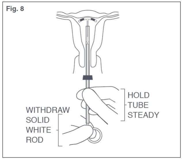 Figure 8: Withdraw Solid White Rod from Uterus 