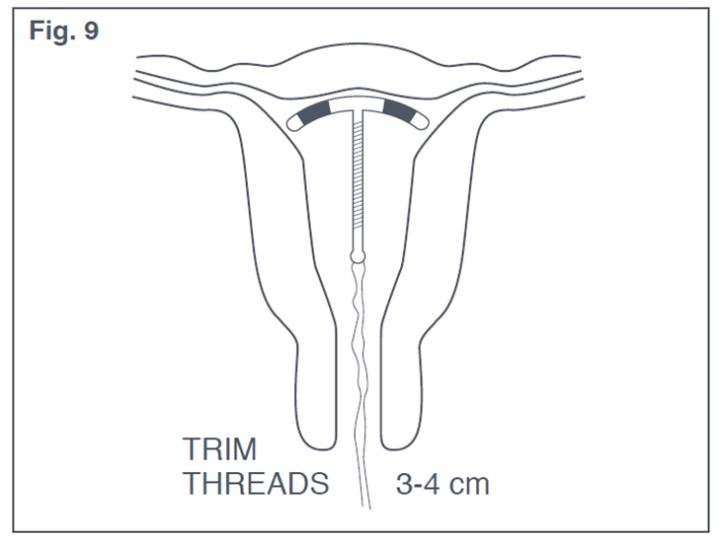 Figure 9: Appropriate Paraguard Placement in Uterus 