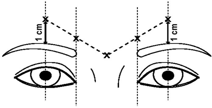 Dysport Face Chart