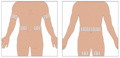 Select the number of infusion sites depending on the volume of the total dose.  See administration for recommended maximum volumes and rates. Potential sites for infusion include the back of arms, abdomen, thighs, and lower back (see Figure below).  Ensure sites are at least 2 inches apart; avoid bony prominences.