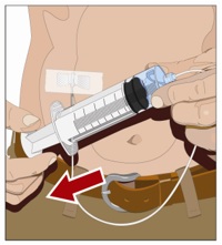 Prior to the start of infusion, check each needle for correct placement to make sure that a blood vessel has not been punctured. Gently pull back on the attached syringe plunger and monitor for any blood return in the needle set.