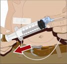 Before starting the infusion, check each needle for correct placement by gently pulling back on the attached syringe plunger and looking for any blood in the needle tubing.  If you see any blood, remove and throw away the needle into the sharps container. Repeat filling (priming) and needle insertion steps in a different infusion site with a new needle.