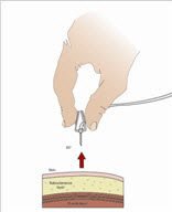 After the infusion is complete, remove the needle set by pulling it straight out. Gently press a small piece of gauze over the needle site and cover with a protective dressing