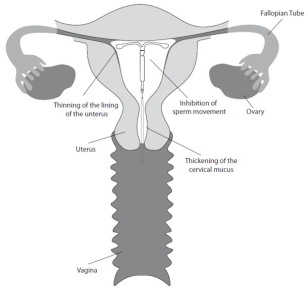 Hogyan lehet fogyni az iud eltávolítása után