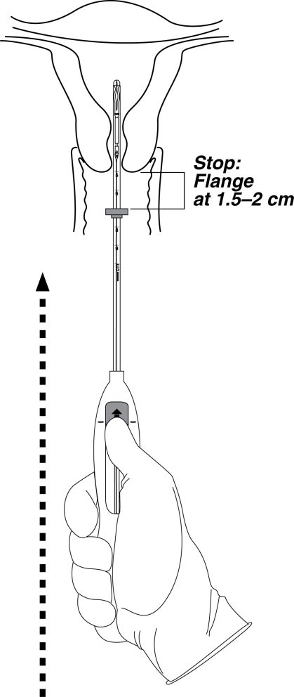 Advancing Tube