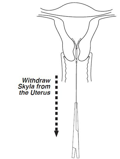 Skyla Iud Fda Prescribing Information Side Effects And Uses 