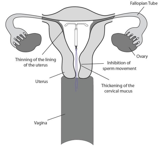 IUD in Uterus