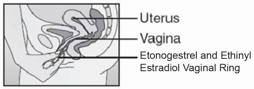 The Vaginal Ring: Is It Right for You?: Associates in Obstetrics &  Gynecology: OB-GYNs