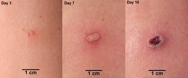 Expected response at ACAM2000 vaccination site in people never vaccinated with a smallpox or mpox vaccine