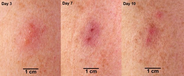Expected response at ACAM2000 vaccination site in people previously vaccinated with a smallpox or mpox vaccine