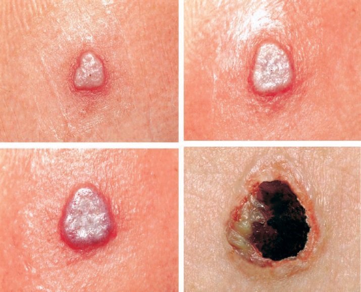 Images of the expected cutaneous reaction after primary vaccination showing progression from a vesicle (Day 5) to a pustule (Days 8-10) to a scab (Day 14).